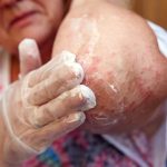 en iyi egzama kremleri