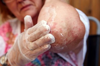 En İyi Egzama Kremi 2025 1 en iyi egzama kremleri